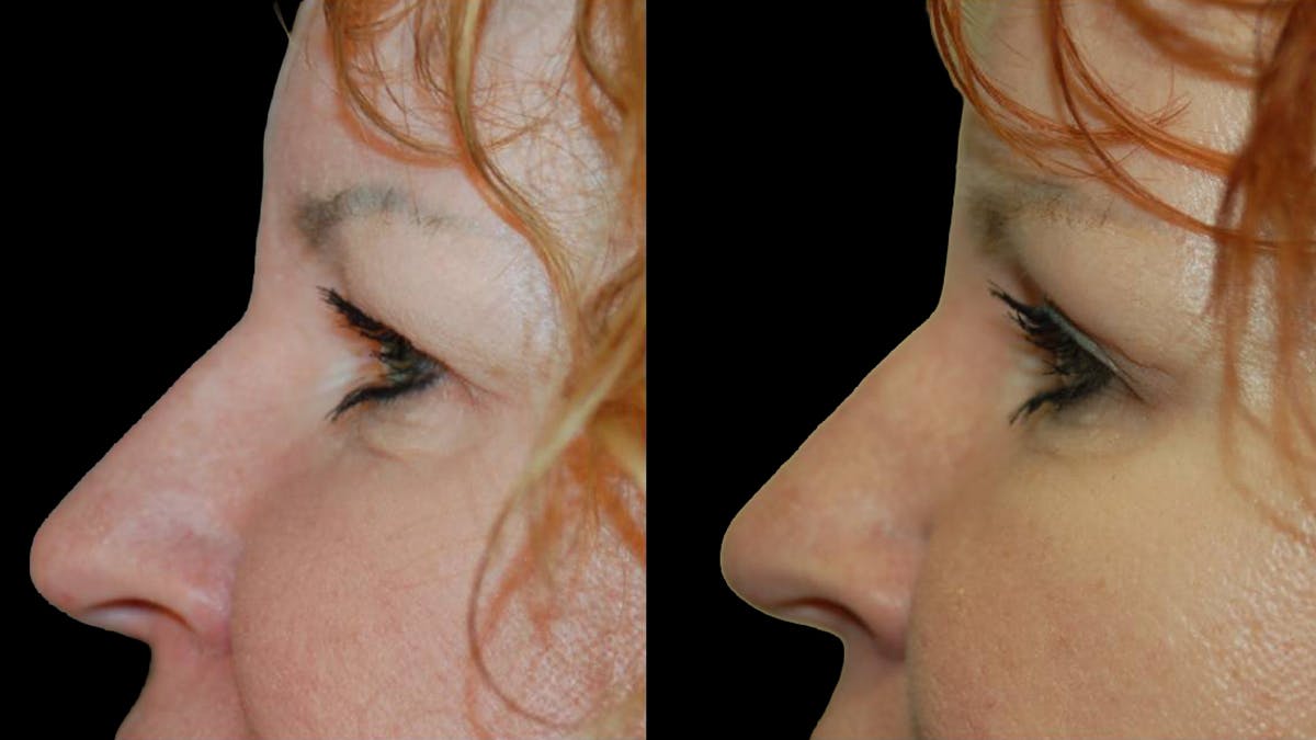 Upper Eyelid Surgery Before & After Gallery - Patient 102634 - Image 5