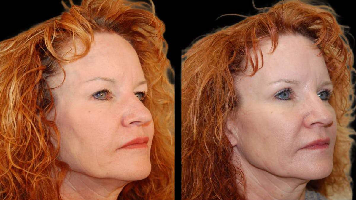 Upper Eyelid Surgery Before & After Gallery - Patient 102634 - Image 6