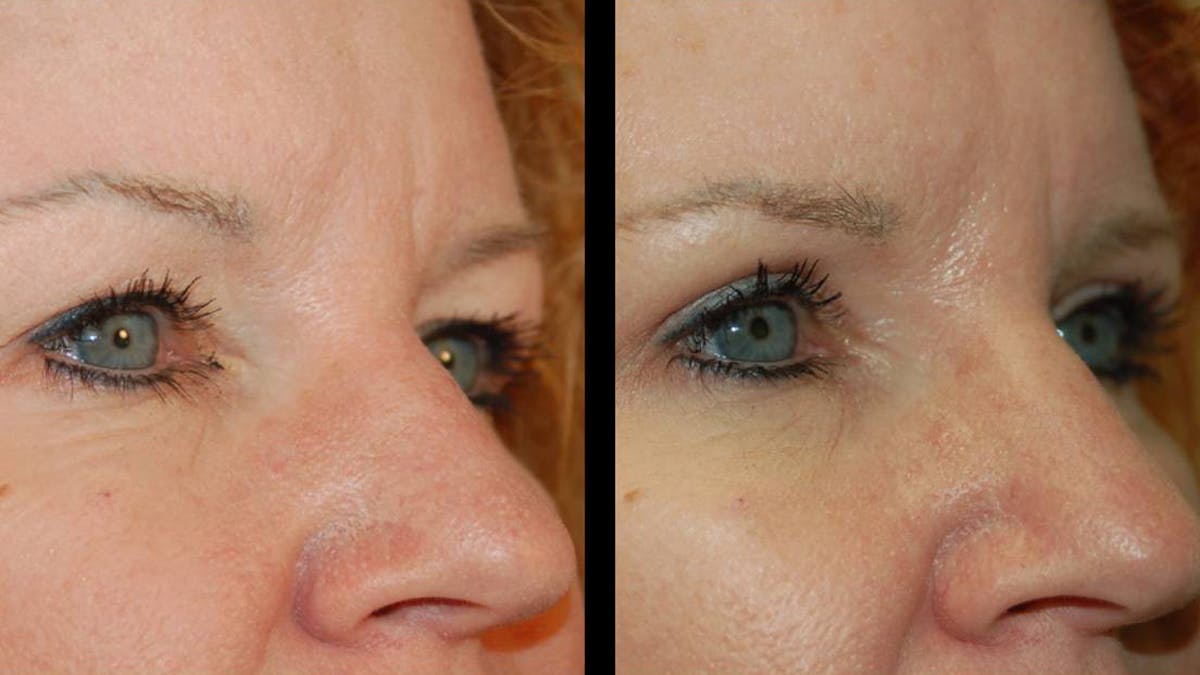 Upper Eyelid Surgery Before & After Gallery - Patient 102634 - Image 7