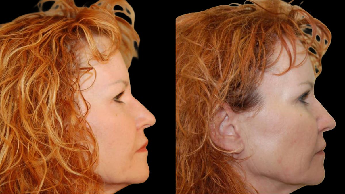 Upper Eyelid Surgery Before & After Gallery - Patient 102634 - Image 8