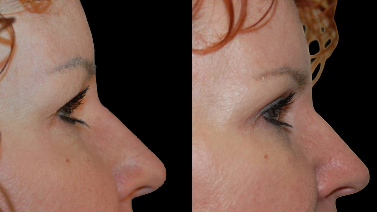 Upper Eyelid Surgery Before & After Gallery - Patient 102634 - Image 9