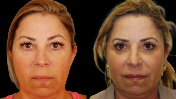 Upper Eyelid Surgery Before & After Gallery - Patient 291040 - Image 1