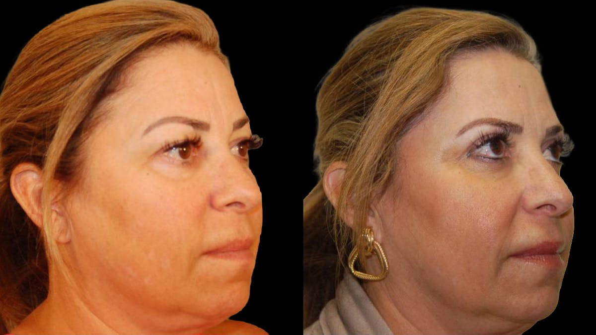 Upper Eyelid Surgery Before & After Gallery - Patient 291040 - Image 2