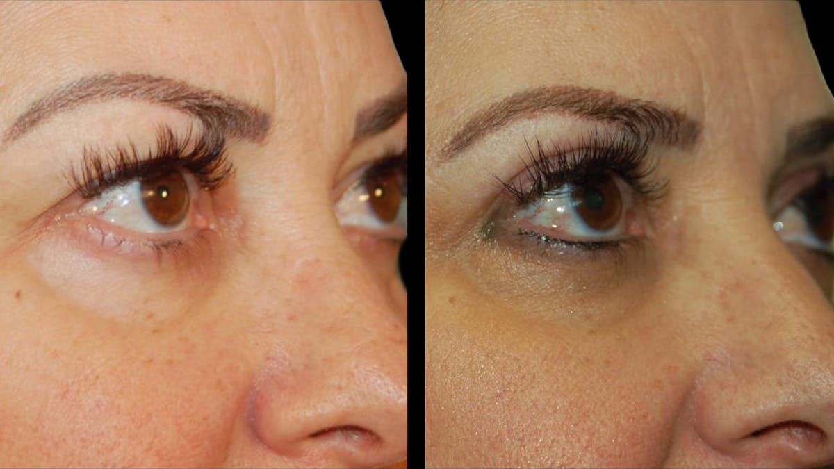 Upper Eyelid Surgery Before & After Gallery - Patient 291040 - Image 3