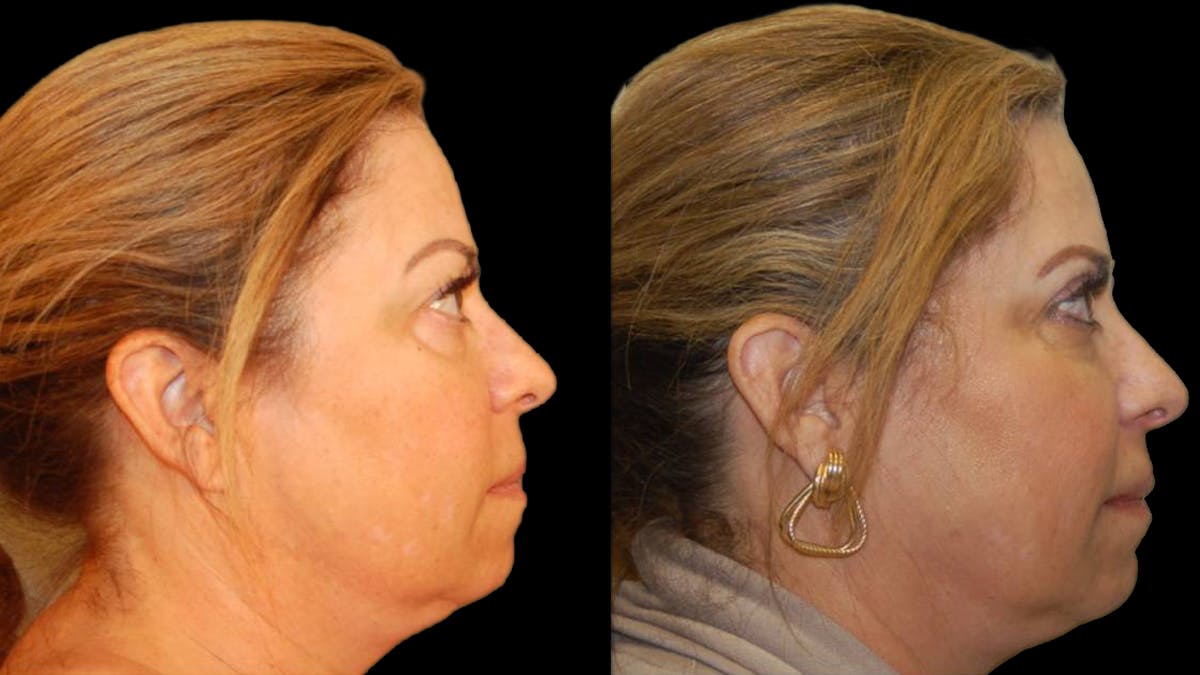 Upper Eyelid Surgery Before & After Gallery - Patient 291040 - Image 4