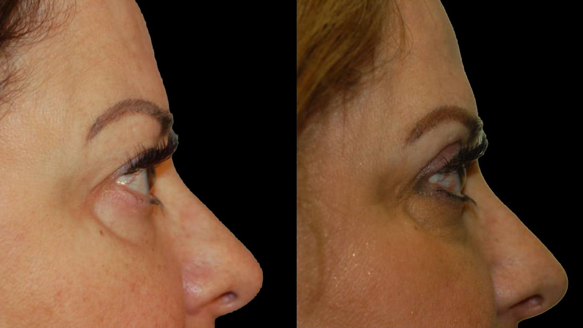Upper Eyelid Surgery Before & After Gallery - Patient 291040 - Image 5