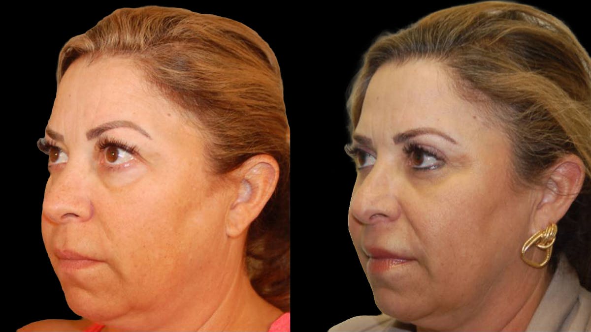 Upper Eyelid Surgery Before & After Gallery - Patient 291040 - Image 6