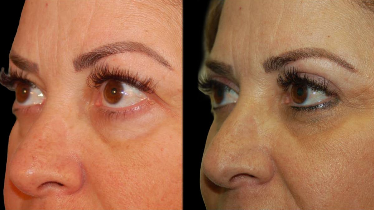 Upper Eyelid Surgery Before & After Gallery - Patient 291040 - Image 7