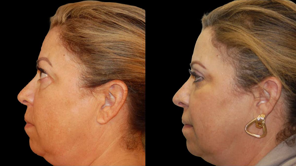 Upper Eyelid Surgery Before & After Gallery - Patient 291040 - Image 8