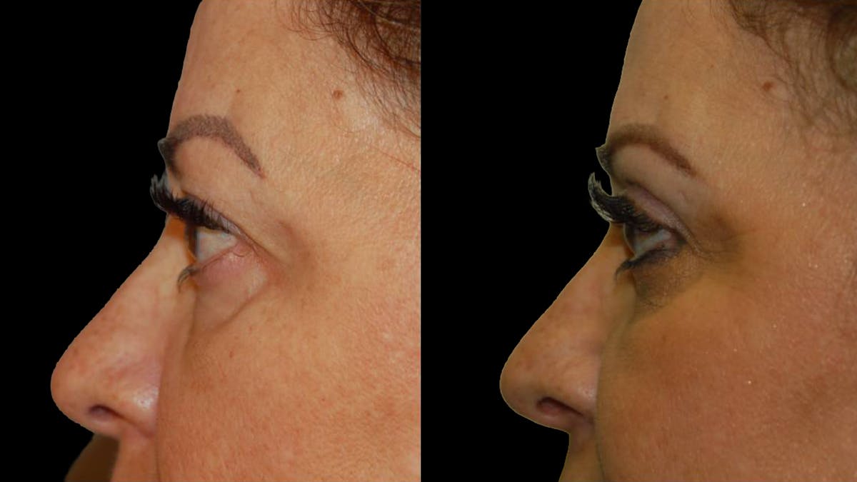 Upper Eyelid Surgery Before & After Gallery - Patient 291040 - Image 9
