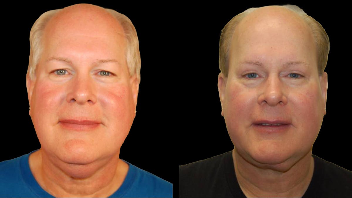 Upper Eyelid Surgery Before & After Gallery - Patient 912562 - Image 1