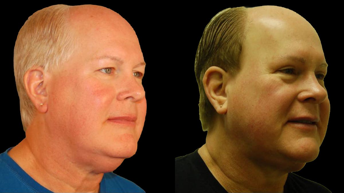 Upper Eyelid Surgery Before & After Gallery - Patient 912562 - Image 2