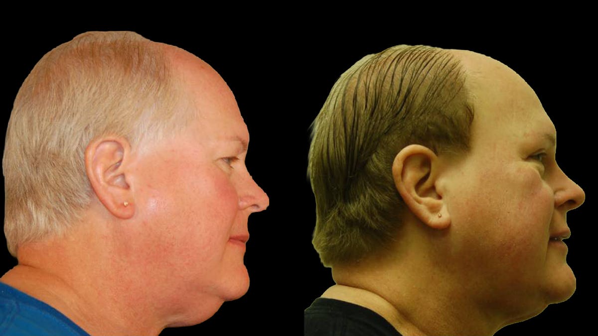 Upper Eyelid Surgery Before & After Gallery - Patient 912562 - Image 3
