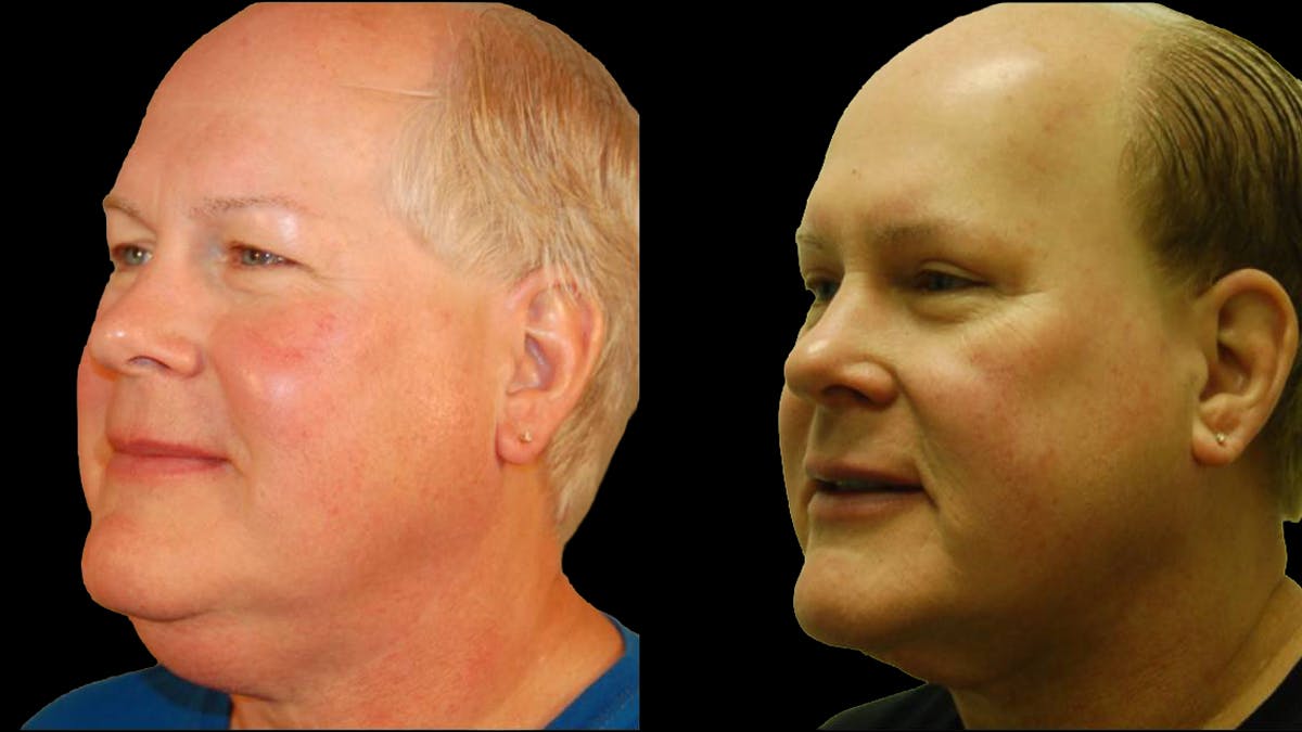Upper Eyelid Surgery Before & After Gallery - Patient 912562 - Image 4