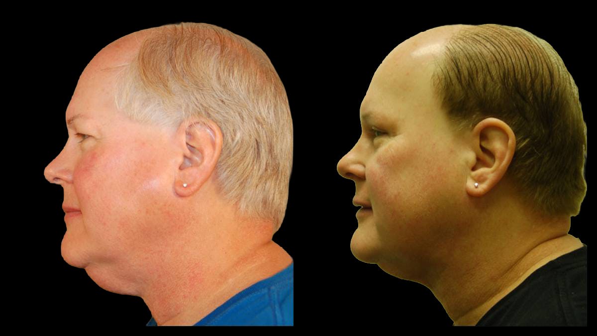 Upper Eyelid Surgery Before & After Gallery - Patient 912562 - Image 5
