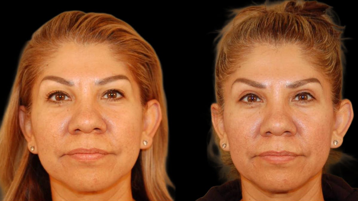Upper Eyelid Surgery Before & After Gallery - Patient 343658 - Image 1