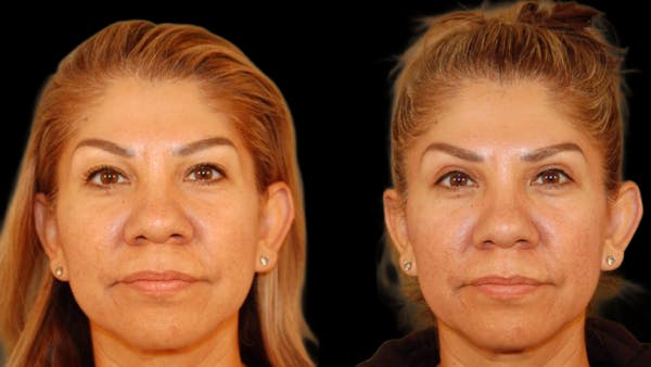 Upper Eyelid Surgery Before & After Gallery - Patient 343658 - Image 1