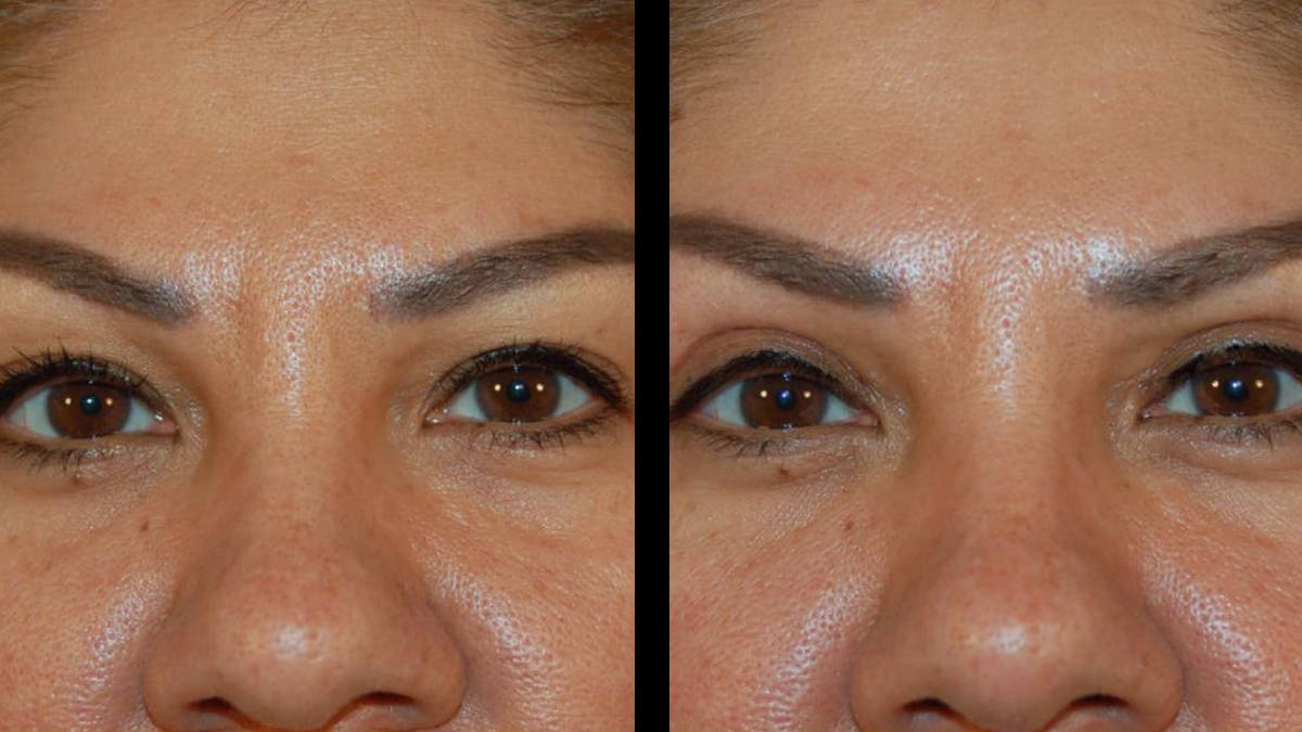 Upper Eyelid Surgery Before & After Gallery - Patient 343658 - Image 5
