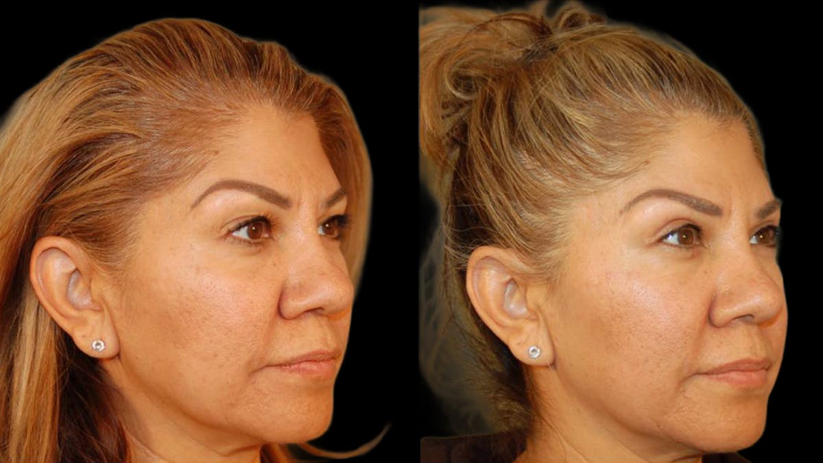 Upper Eyelid Surgery Before & After Gallery - Patient 343658 - Image 2
