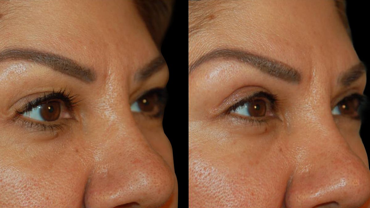 Upper Eyelid Surgery Before & After Gallery - Patient 343658 - Image 4