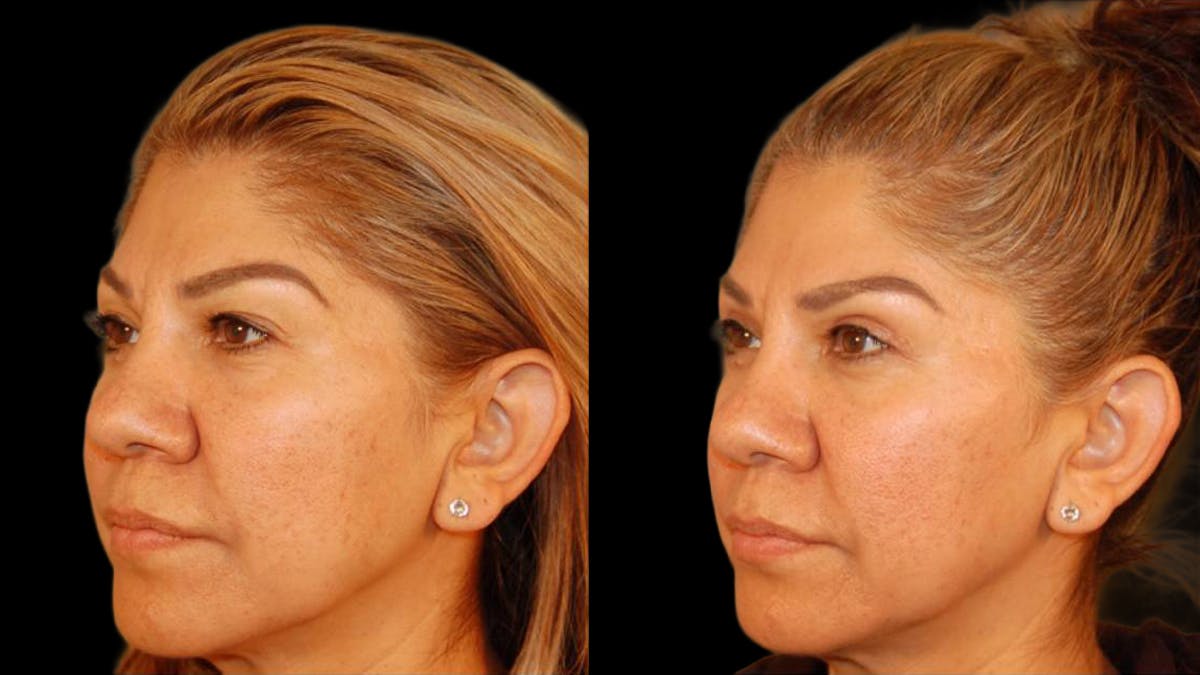 Upper Eyelid Surgery Before & After Gallery - Patient 343658 - Image 3