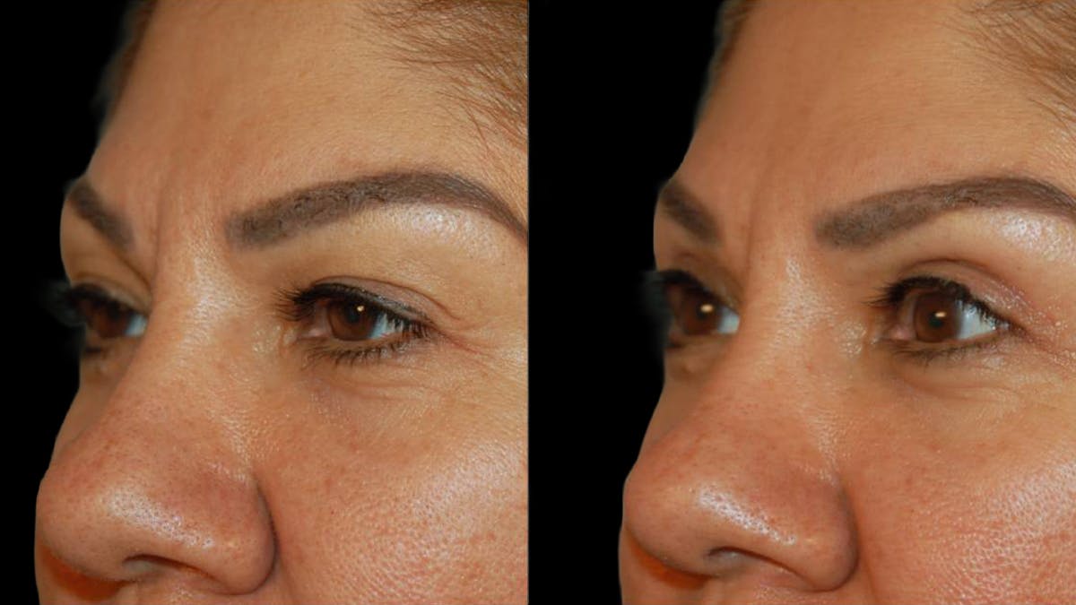 Upper Eyelid Surgery Before & After Gallery - Patient 343658 - Image 6