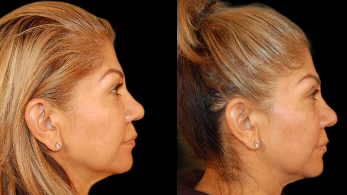Upper Eyelid Surgery Before & After Gallery - Patient 343658 - Image 7