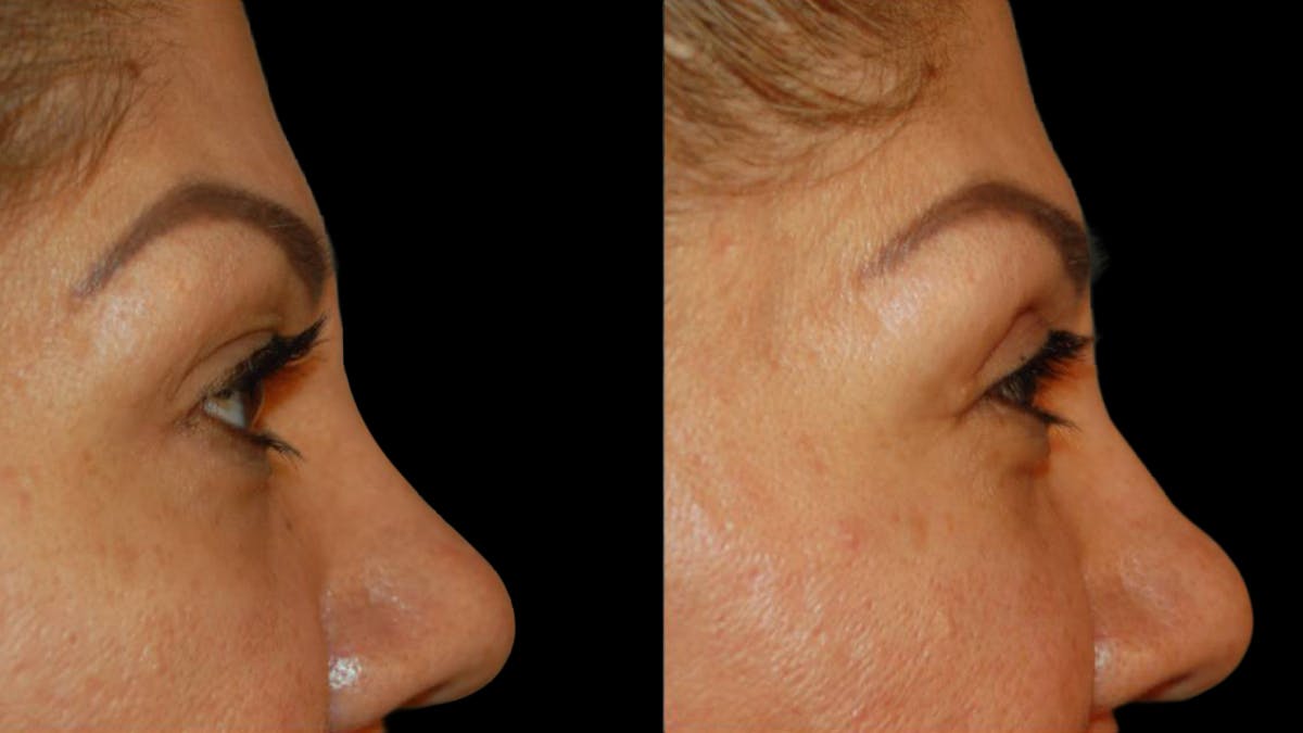 Upper Eyelid Surgery Before & After Gallery - Patient 343658 - Image 8