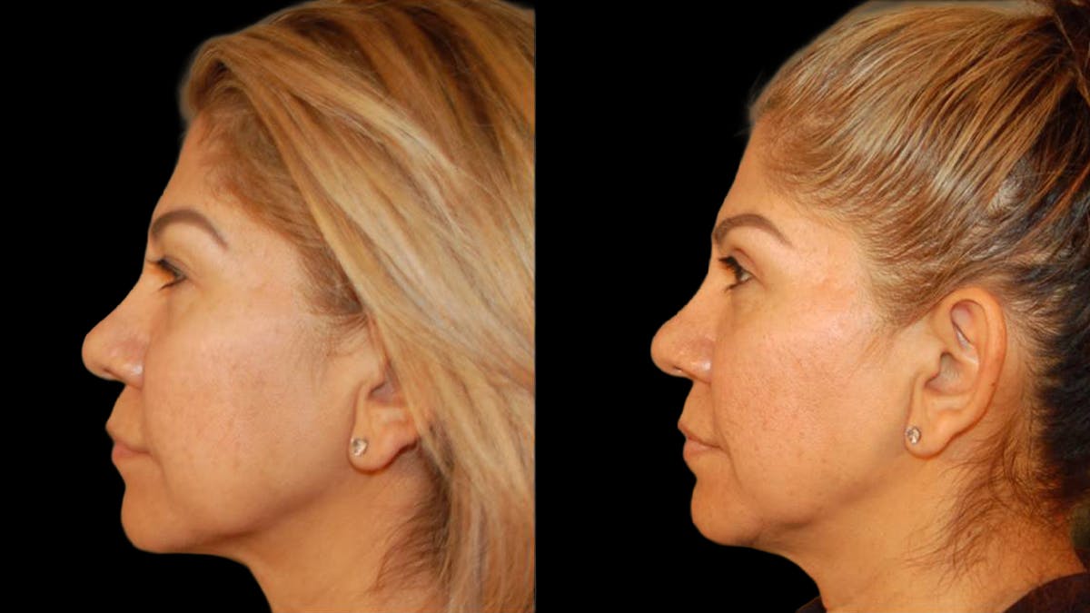 Upper Eyelid Surgery Before & After Gallery - Patient 343658 - Image 9