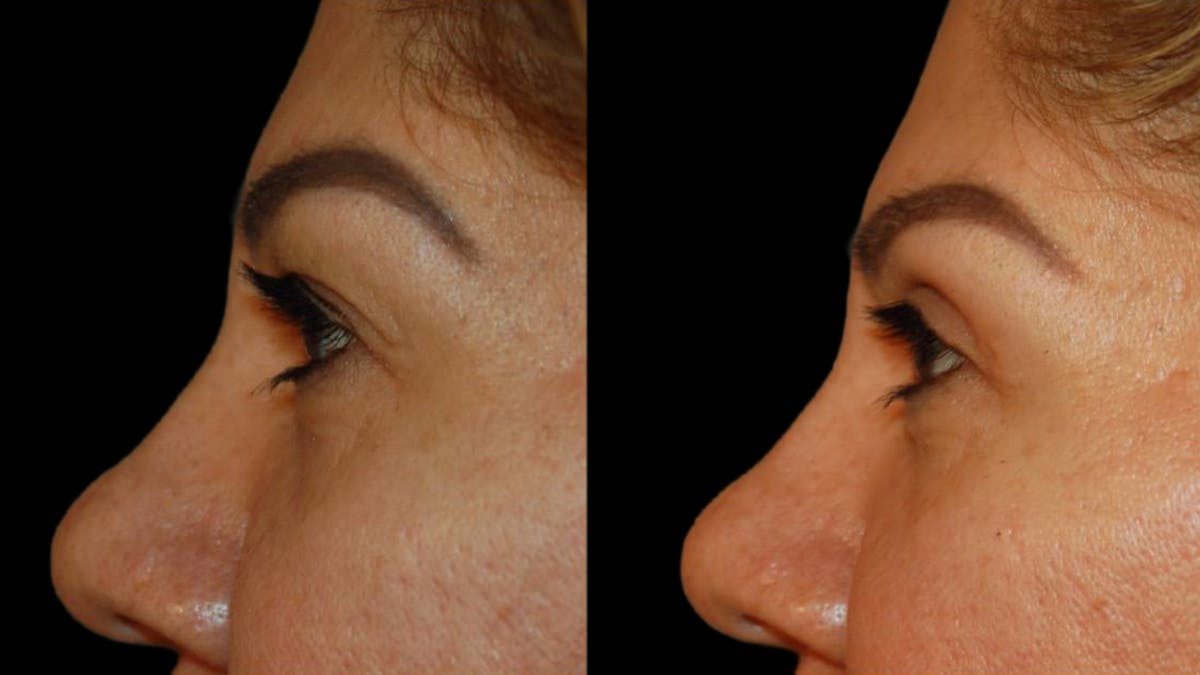Upper Eyelid Surgery Before & After Gallery - Patient 343658 - Image 10