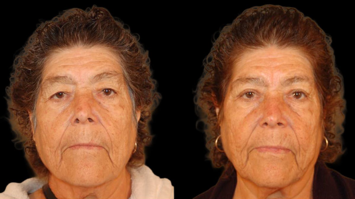 Upper Eyelid Surgery Before & After Gallery - Patient 509847 - Image 1