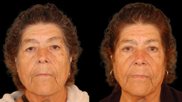 Upper Eyelid Surgery Before & After Gallery - Patient 509847 - Image 1