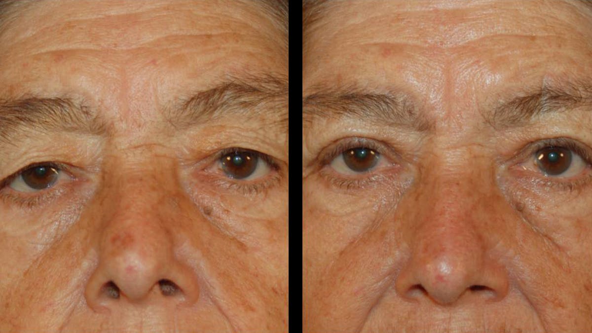 Upper Eyelid Surgery Before & After Gallery - Patient 509847 - Image 9