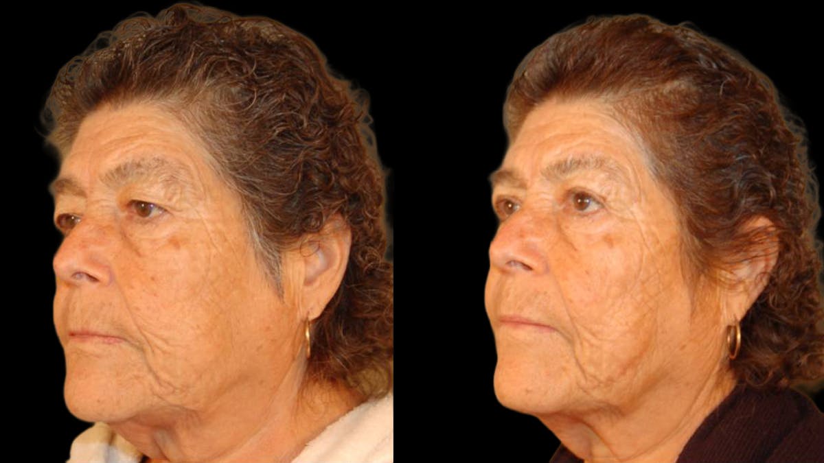 Upper Eyelid Surgery Before & After Gallery - Patient 509847 - Image 2