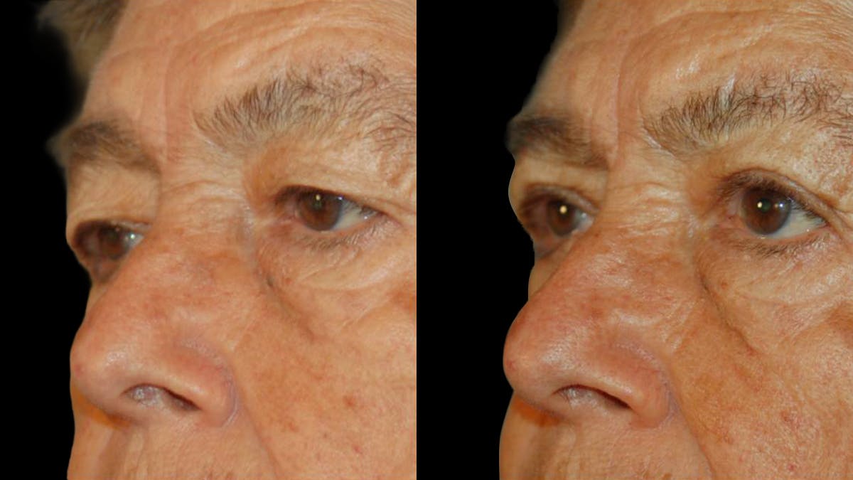 Upper Eyelid Surgery Before & After Gallery - Patient 509847 - Image 6