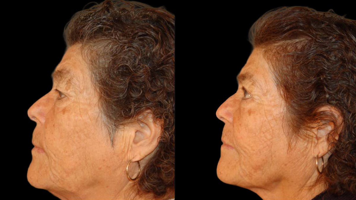 Upper Eyelid Surgery Before & After Gallery - Patient 509847 - Image 4
