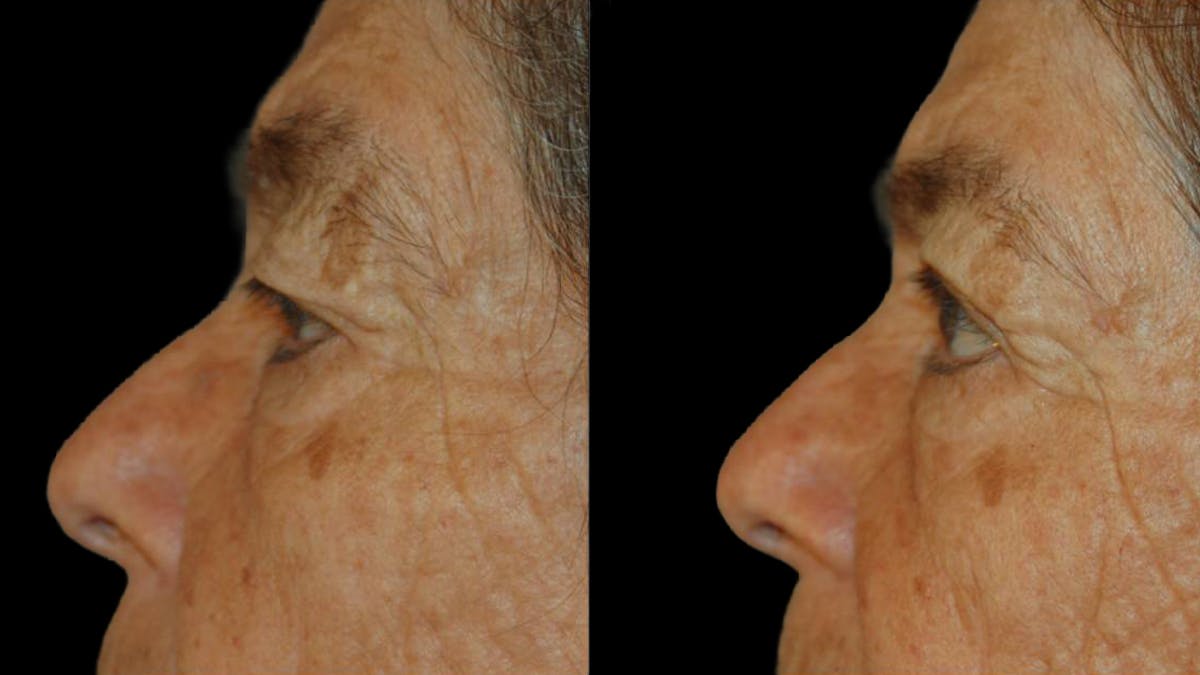Upper Eyelid Surgery Before & After Gallery - Patient 509847 - Image 7
