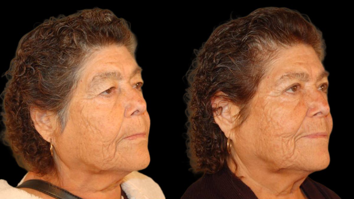 Upper Eyelid Surgery Before & After Gallery - Patient 509847 - Image 3