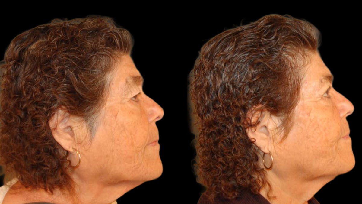 Upper Eyelid Surgery Before & After Gallery - Patient 509847 - Image 5