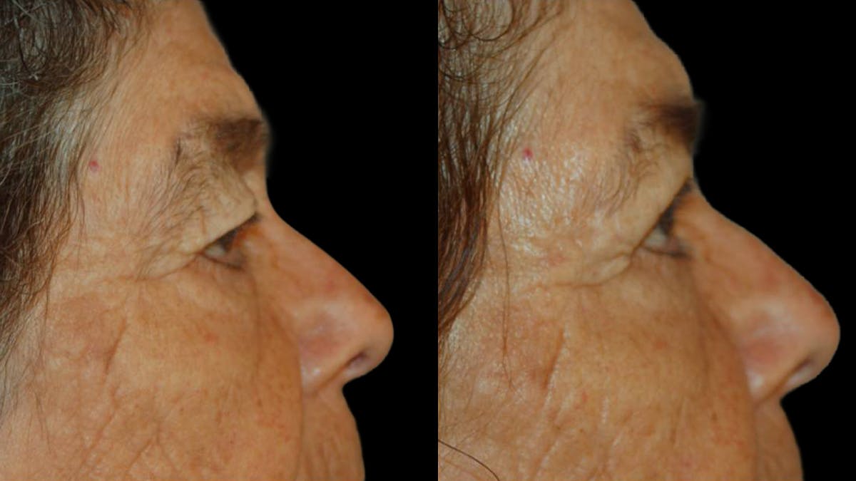 Upper Eyelid Surgery Before & After Gallery - Patient 509847 - Image 10