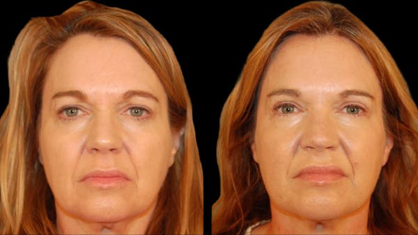 Upper Eyelid Surgery Before & After Gallery - Patient 361195 - Image 1
