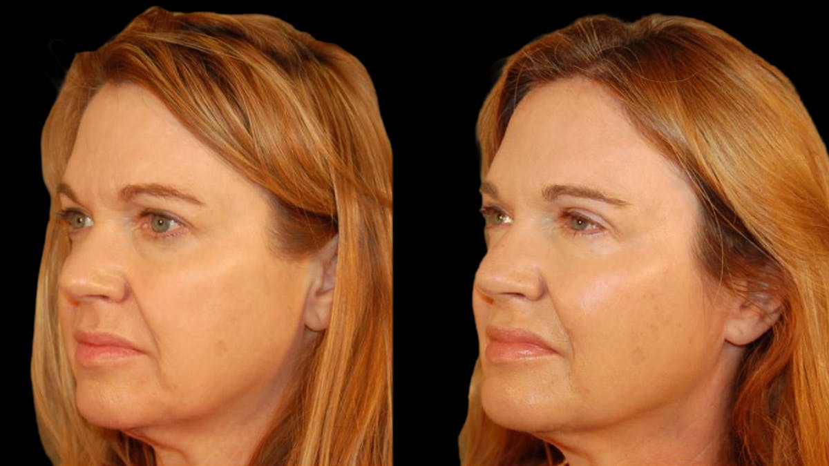 Upper Eyelid Surgery Before & After Gallery - Patient 361195 - Image 2