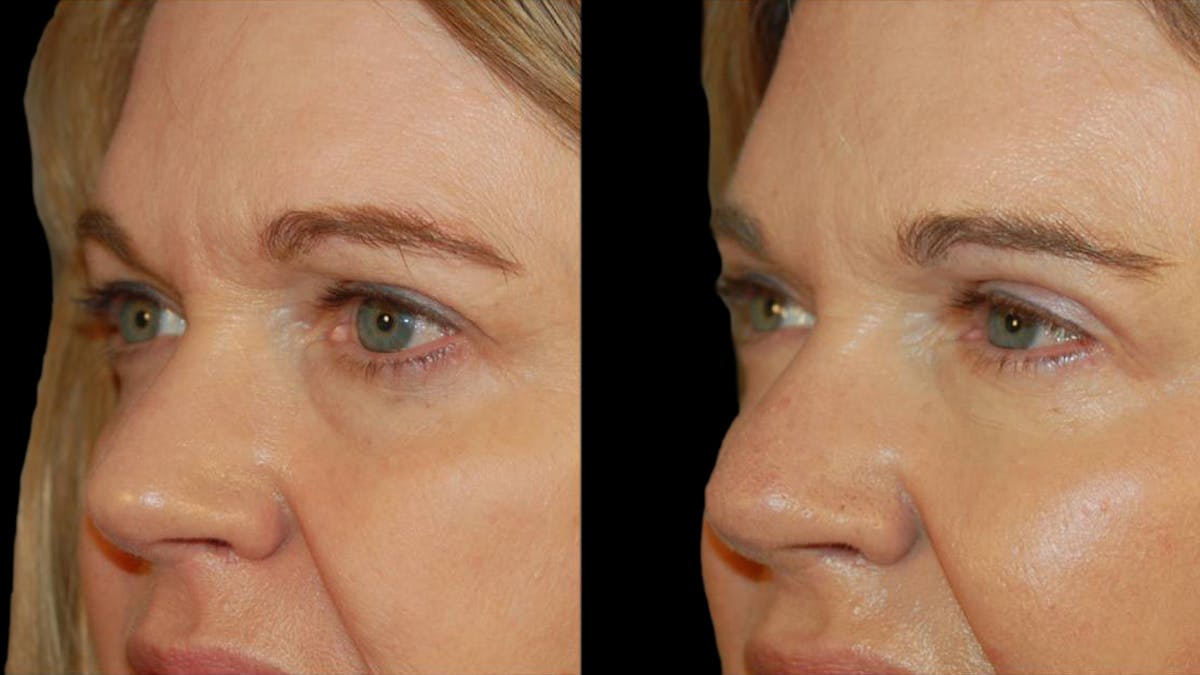 Upper Eyelid Surgery Before & After Gallery - Patient 361195 - Image 3