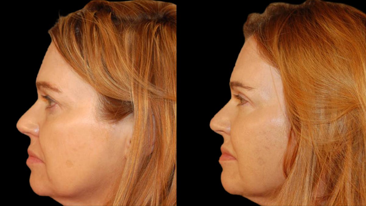 Upper Eyelid Surgery Before & After Gallery - Patient 361195 - Image 4