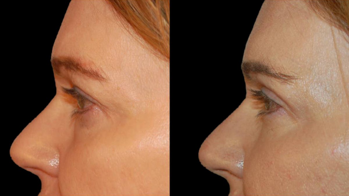 Upper Eyelid Surgery Before & After Gallery - Patient 361195 - Image 5