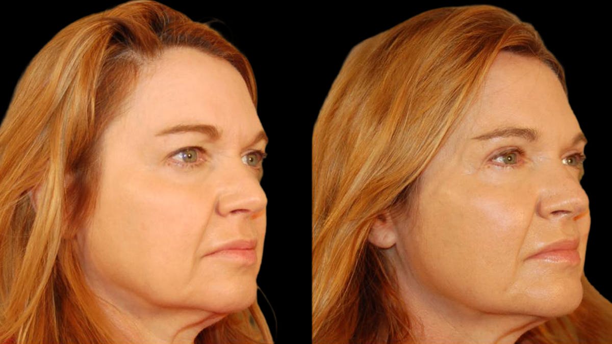 Upper Eyelid Surgery Before & After Gallery - Patient 361195 - Image 6