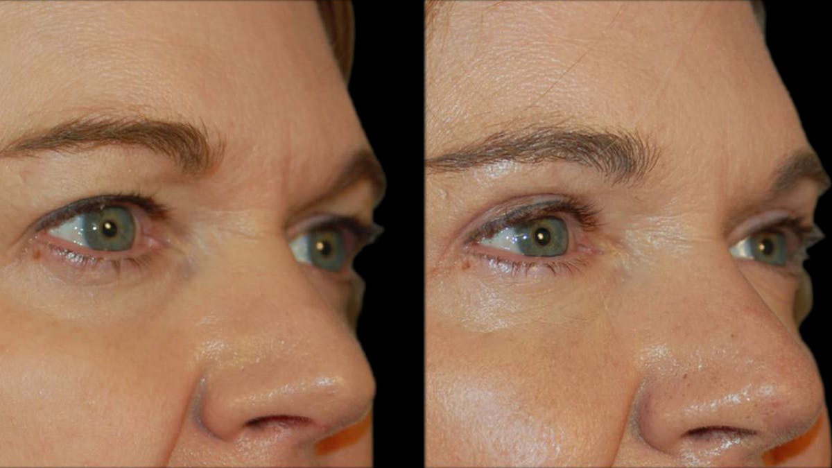 Upper Eyelid Surgery Before & After Gallery - Patient 361195 - Image 7