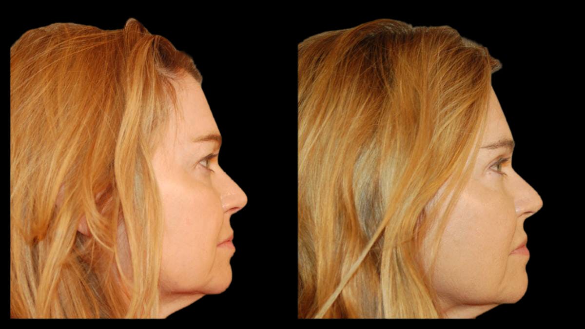 Upper Eyelid Surgery Before & After Gallery - Patient 361195 - Image 8