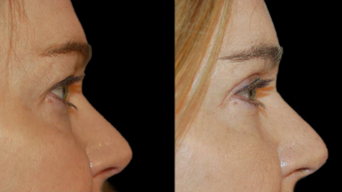 Upper Eyelid Surgery Before & After Gallery - Patient 361195 - Image 9