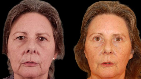 Upper Eyelid Surgery Before & After Gallery - Patient 816568 - Image 1